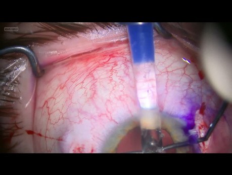 Intrascleral Fixation of Carlevale Combined with Decrease of the Pupil Size