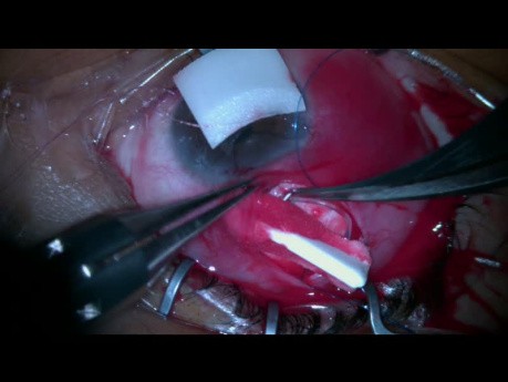Implant drenujący w jaskrze