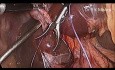 Cholecystektomia laparoskopowa z podwiązaniem przewodu pęcherzykowego