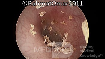 Nagromadzenie złuszczone nabłonków w przewodzie słuchowym 