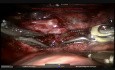 Robotowa resekcja segmentu płuca