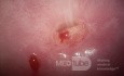 Endometrioza szyjki macicy