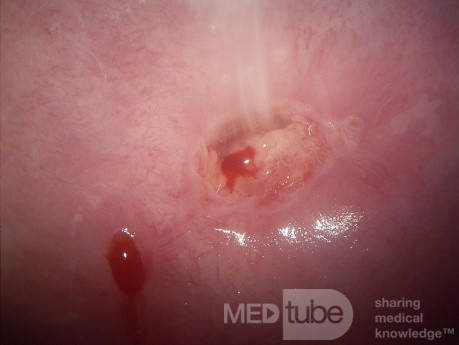 Endometrioza szyjki macicy