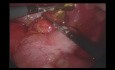 Laparoskopowe usunięcie perforowanego ciała obcego imitującego ostre zapalenie wyrostka robaczkowego z perforacją