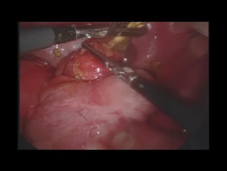 Laparoskopowe usunięcie perforowanego ciała obcego imitującego ostre zapalenie wyrostka robaczkowego z perforacją