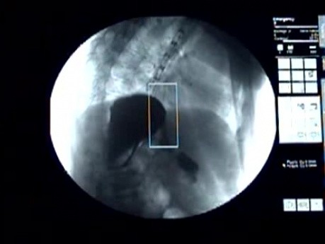 Niedrożność Przełyku - Widok Fluoroskopowy