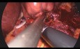 Laparoskopowe wycięcie I segmentu wątroby