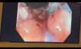 Mukozektomia endoskopowa polipa jelita grubego