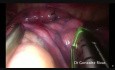Przednia górna segmentektomia lewostronna sposobem VATS z pojedynczego dostępu (resekcja segmentu 3 płuca lewego)