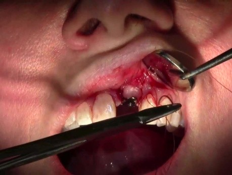 Wszczepienie implantu - #9 - technika szycia
