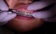 Łańcuszek ortodontyczny - aktualizacja ortodontyczna (