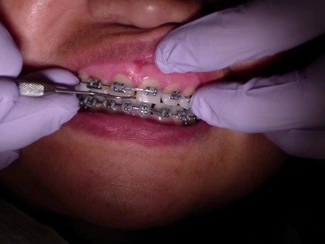 Łańcuszek ortodontyczny - aktualizacja ortodontyczna (