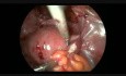 Histerektomia laparoskopowa - obecność dużych zrostów