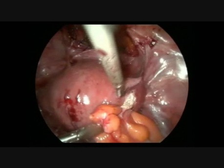 Histerektomia laparoskopowa - obecność dużych zrostów