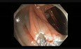 Kolonoskopia - EMR płaskiego-siedzącego polipa w zgięciu wątrobowym okrężnicy