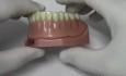 Proteza oparta na implantach - model