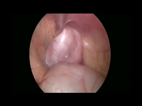 Obustronna laparoskopowa operacja wnętrostwa (orchidopeksja)