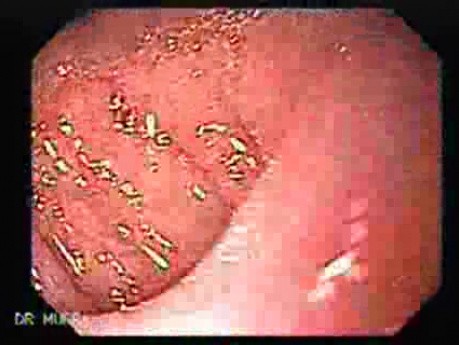 Gruczolakorak krzywizny mniejszej po gastrektomii typu Billroth II (3 z 3)