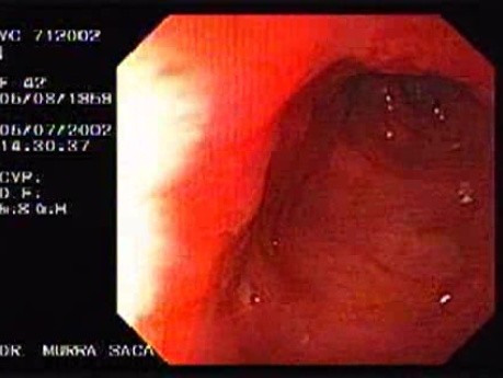 Choroba Leśniowskiego - Crohna - endoskopia (21 z 28)
