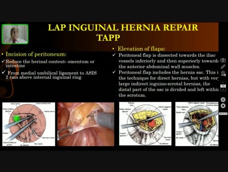 Operacje przepuklin pachwinowych metodą laparoskopową