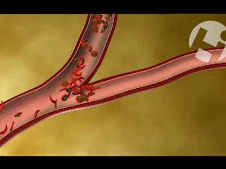 Zator żylny i anemia sierpowata