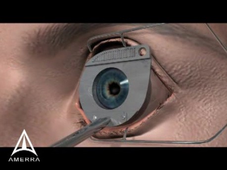 LASIK - Laserowa korekcja wzroku
