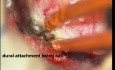 Mikrochirurgiczne usunięcie guza kanału kręgowego o typie oponiaka - przypadek 2