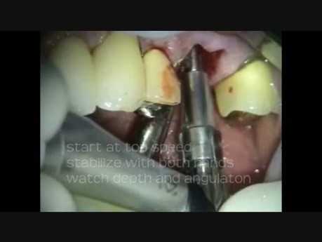Mikrochirurgia periodontologiczna: natychmiastowa implantacja trzonowca szczęki