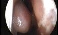 Alergiczny nieżyt nosa - znaleziska podczas endoskopii jamy nosowej