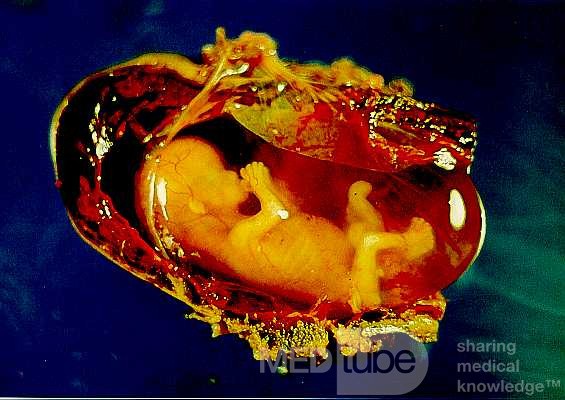 Zaawansowana ciąża ektopowa