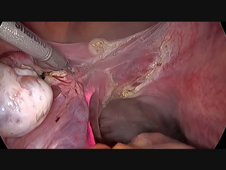 Całkowita laparoskopowa histerektomia ze stentowaniem moczowodu