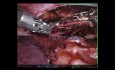 Zespół górnego otworu klatki piersiowej - usunięcie pierwszego żebra