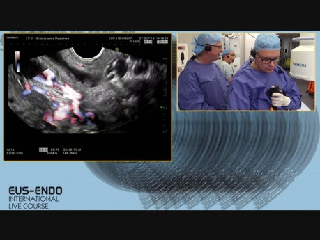 Ultrasonografia endoskopowa (EUS) i endoskopowa cholangiopankreatografia wsteczna (ECPW)