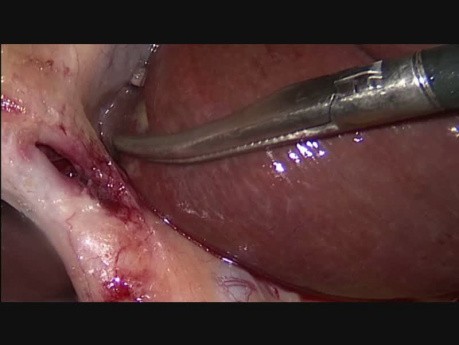 Prosta cholecystektomia laparoskopowa
