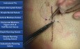 Techniki szycia chirurgicznego - szew materacowy pionowy