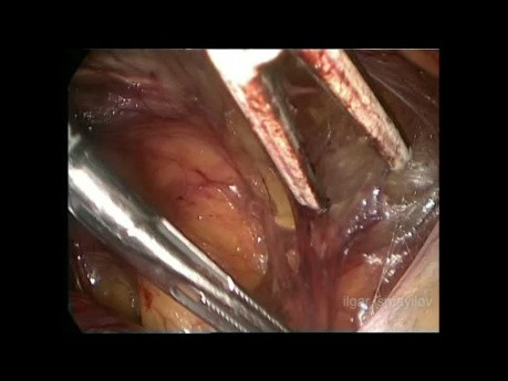 Laparoskopowa operacja przepukliny pachwinowej zawierającej pęcherz moczowy metodą TEP