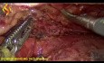 Torakolaparoskopowa ezofagektomia - część 4