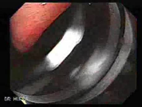 Endoskopowy obraz żołądka klepsydrowatego, część 2