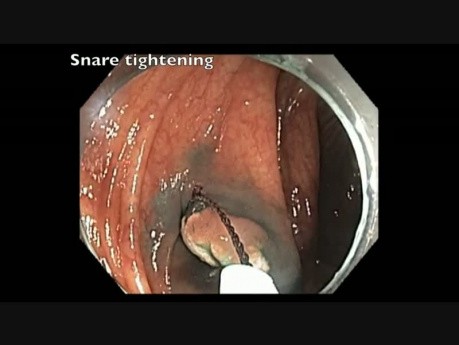 Endoskopowa resekcja śluzówkowa polipa - płukanie cewnika przed ostrzykiwaniem