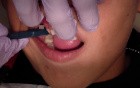 Osadzenie Pierścieni Ortodontycznych