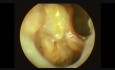 Badanie endoskopowe ucha po operacji usunięcia perlaka wrodzonego