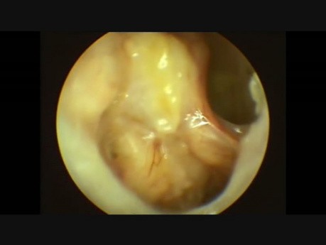 Badanie endoskopowe ucha po operacji usunięcia perlaka wrodzonego
