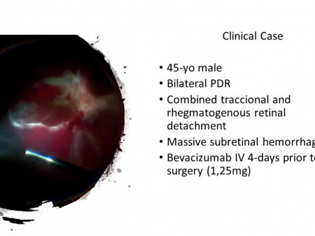 Duży krwotok podsiatkówowy i mieszane odwarstwienie siatkówki