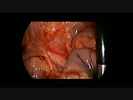 Laparoskopowa resekcja skręconego wewnątrzmacicznie jajnika u noworodka