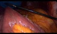 Operacja żołądka metodą Gastric bypass - część 2