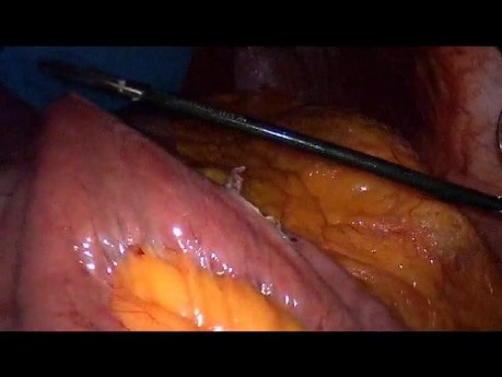 Operacja żołądka metodą Gastric bypass - część 2