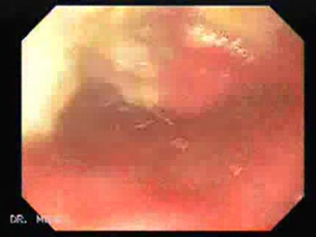 Rak gruczołowy trzonu i jamy odźwiernikowej (1 z 5)