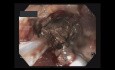 Bezpośrednia endoskopowa nekrozektomia