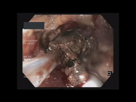 Bezpośrednia endoskopowa nekrozektomia
