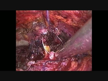 Zespolenie pęcherza z cewką moczową - pierwszy szew - laparoskopowa radykalna prostatektomia
